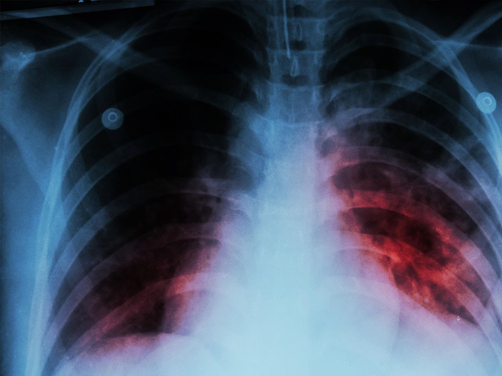 Coatepeque ocupa el primer lugar en casos de tuberculosis de Quetzaltenango